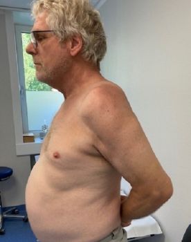 Bild Patient Schulterluxation nach der OP
