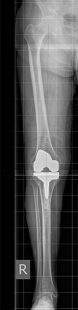 Röntgenbild postoperatives Resultat nach Versorgung mit Roboter assistierter Knieprothese
