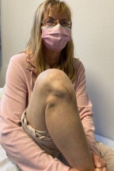 Bild Starplatte Ergebnis Patientin zeigt ihre Narbe am Knie