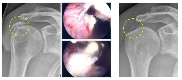 Röntgenbild die Kalkablagerungen in der Sehne werden bei einer Arthroskopie entfernt