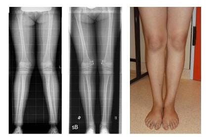 Die Röntgenbilder zeigen die Korrektur der X-Beine durch Klammerung der Wachstumsfugen nach 10 Monaten