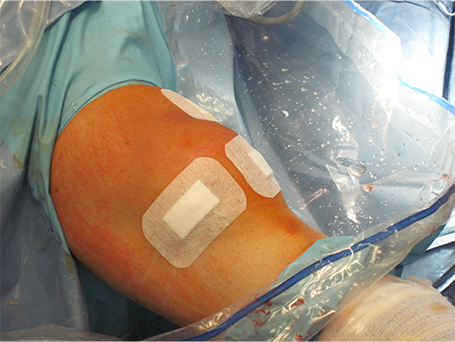 Bild Knie nach Arthroskopie