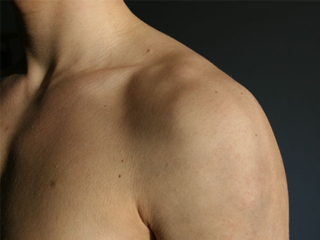 Bild von der linken Schulter eines Patienten