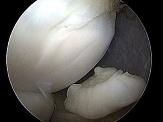Bild Fragment Ellenbogen bei Osteochondrosis dissecans Bild Fragment Ellenbogen bei Osteochondrosis dissecans