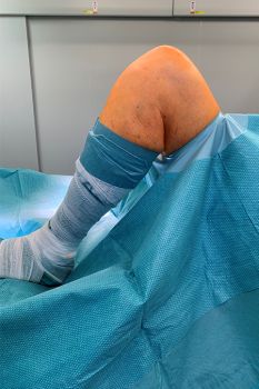 Bild Knie seitlich im OP Bild Knie seitlich im OP